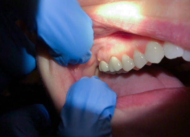 Best Tooth Infection Emergency Dentist  in Ironwood, MI